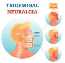 Trigeminal Neuralgia Treatment-Best Neurosurgeon in Lahore